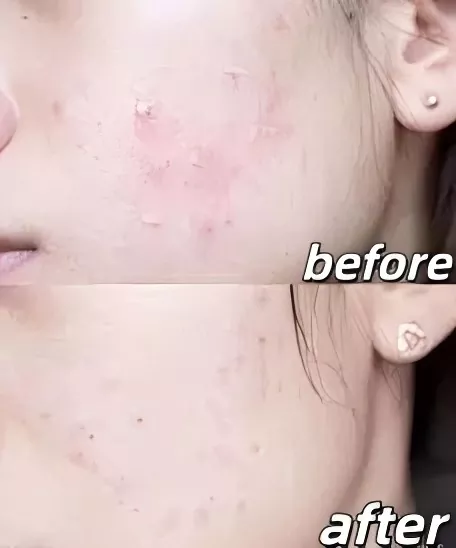 Acne-Reducing Liquid Dressing