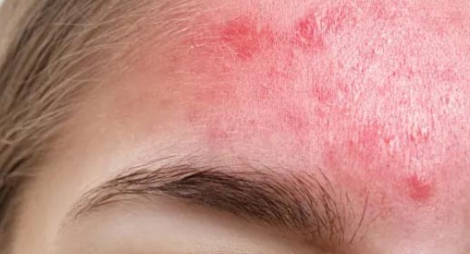 Hyaluronic Acid Anti-Allergy Essence